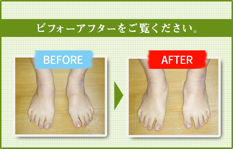 外反母趾の改善