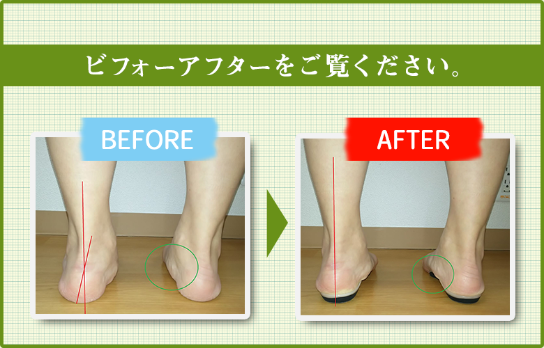 インソールで矯正された様子
